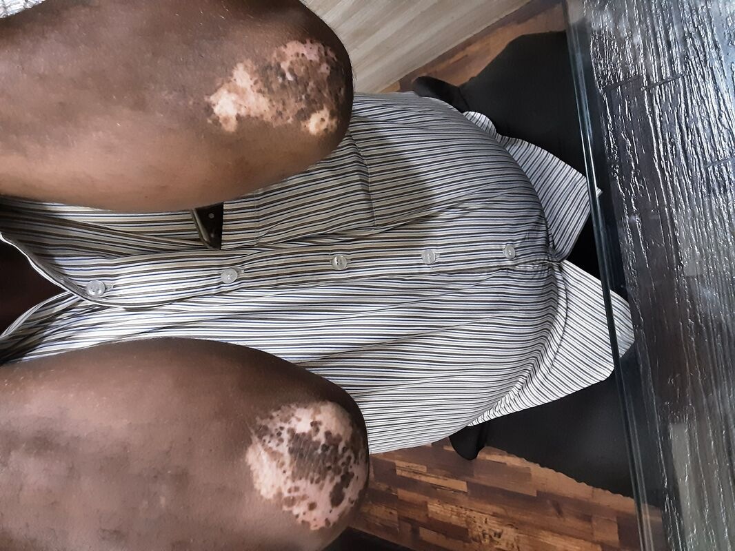 case of vitiligo1